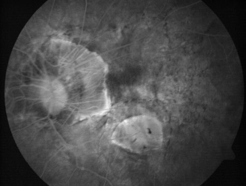 Myopic Macular Degeneration - Staphyloma - Recent Vision Loss Right Eye - Possible CNVM
83-year-old woman is a high myope with myopic macular degeneration.  She had a retinal detachment repair in the right eye in 1968.  I saw her in June of 2003.  She had posterior colobomas and areas of pigment epithelial atrophy.  She has noticed over the last six weeks substantial declining vision in the right eye.  Prior to that, the vision in the two eyes was about the same.  She uses Xalatan in the left eye and Alphagan in both eyes.

VISUAL ACUITY:  Vision OD is 20/160, OS is 20/40
