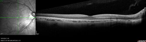 Myopic (maybe PIC) choroidal neovascular membrane with recurrence after 6 years
31 year old female presented with 20/100 vision OS in 2017.  Was treated with Lucentis x 6 and improved to 20/32.  Then she was lost to follow-up.  She represented 6 years later with 20/50 vision OS and a large recurrence and restarted treatment.
