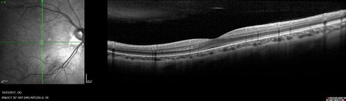 Myopic (maybe PIC) choroidal neovascular membrane with recurrence after 6 years
31 year old female presented with 20/100 vision OS in 2017.  Was treated with Lucentis x 6 and improved to 20/32.  Then she was lost to follow-up.  She represented 6 years later with 20/50 vision OS and a large recurrence and restarted treatment.
