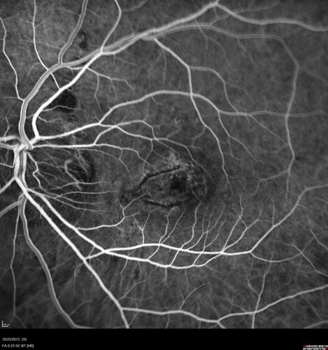 Myopic (maybe PIC) choroidal neovascular membrane with recurrence after 6 years
31 year old female presented with 20/100 vision OS in 2017.  Was treated with Lucentis x 6 and improved to 20/32.  Then she was lost to follow-up.  She represented 6 years later with 20/50 vision OS and a large recurrence and restarted treatment.
