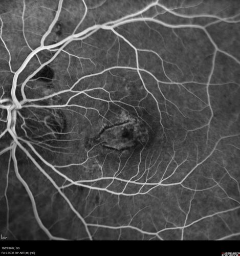 Myopic (maybe PIC) choroidal neovascular membrane with recurrence after 6 years
31 year old female presented with 20/100 vision OS in 2017.  Was treated with Lucentis x 6 and improved to 20/32.  Then she was lost to follow-up.  She represented 6 years later with 20/50 vision OS and a large recurrence and restarted treatment.
