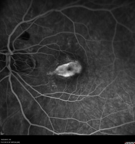 Myopic (maybe PIC) choroidal neovascular membrane with recurrence after 6 years
31 year old female presented with 20/100 vision OS in 2017.  Was treated with Lucentis x 6 and improved to 20/32.  Then she was lost to follow-up.  She represented 6 years later with 20/50 vision OS and a large recurrence and restarted treatment.

