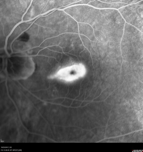Myopic (maybe PIC) choroidal neovascular membrane with recurrence after 6 years
31 year old female presented with 20/100 vision OS in 2017.  Was treated with Lucentis x 6 and improved to 20/32.  Then she was lost to follow-up.  She represented 6 years later with 20/50 vision OS and a large recurrence and restarted treatment.

