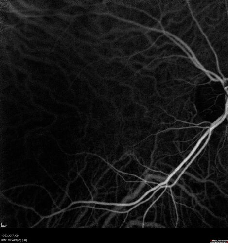 Myopic (maybe PIC) choroidal neovascular membrane with recurrence after 6 years
31 year old female presented with 20/100 vision OS in 2017.  Was treated with Lucentis x 6 and improved to 20/32.  Then she was lost to follow-up.  She represented 6 years later with 20/50 vision OS and a large recurrence and restarted treatment.
