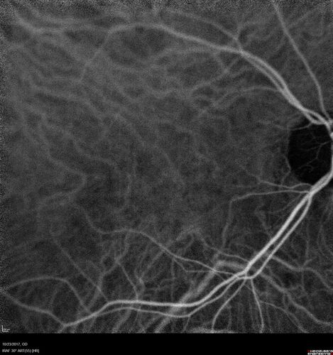 Myopic (maybe PIC) choroidal neovascular membrane with recurrence after 6 years
31 year old female presented with 20/100 vision OS in 2017.  Was treated with Lucentis x 6 and improved to 20/32.  Then she was lost to follow-up.  She represented 6 years later with 20/50 vision OS and a large recurrence and restarted treatment.
