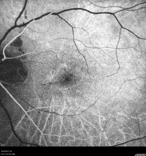 Myopic (maybe PIC) choroidal neovascular membrane with recurrence after 6 years
31 year old female presented with 20/100 vision OS in 2017.  Was treated with Lucentis x 6 and improved to 20/32.  Then she was lost to follow-up.  She represented 6 years later with 20/50 vision OS and a large recurrence and restarted treatment.
