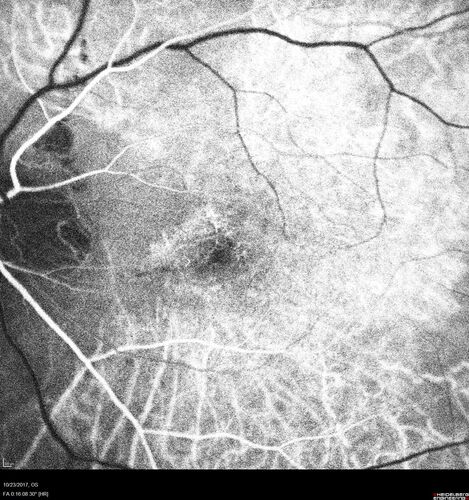 Myopic (maybe PIC) choroidal neovascular membrane with recurrence after 6 years
31 year old female presented with 20/100 vision OS in 2017.  Was treated with Lucentis x 6 and improved to 20/32.  Then she was lost to follow-up.  She represented 6 years later with 20/50 vision OS and a large recurrence and restarted treatment.
