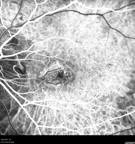 Myopic (maybe PIC) choroidal neovascular membrane with recurrence after 6 years
31 year old female presented with 20/100 vision OS in 2017.  Was treated with Lucentis x 6 and improved to 20/32.  Then she was lost to follow-up.  She represented 6 years later with 20/50 vision OS and a large recurrence and restarted treatment.
