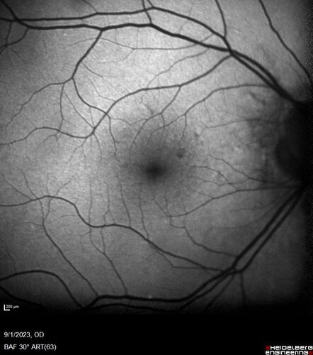 Myopic (maybe PIC) choroidal neovascular membrane with recurrence after 6 years
31 year old female presented with 20/100 vision OS in 2017.  Was treated with Lucentis x 6 and improved to 20/32.  Then she was lost to follow-up.  She represented 6 years later with 20/50 vision OS and a large recurrence and restarted treatment.
