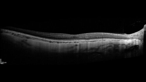 Myopic (maybe PIC) choroidal neovascular membrane with recurrence after 6 years
31 year old female presented with 20/100 vision OS in 2017.  Was treated with Lucentis x 6 and improved to 20/32.  Then she was lost to follow-up.  She represented 6 years later with 20/50 vision OS and a large recurrence and restarted treatment.
