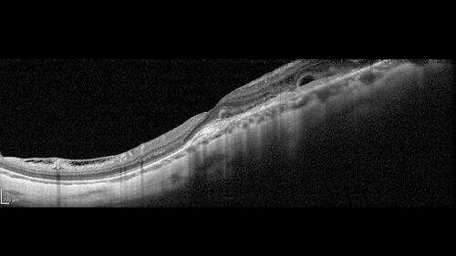 Myopic (maybe PIC) choroidal neovascular membrane with recurrence after 6 years
31 year old female presented with 20/100 vision OS in 2017.  Was treated with Lucentis x 6 and improved to 20/32.  Then she was lost to follow-up.  She represented 6 years later with 20/50 vision OS and a large recurrence and restarted treatment.
