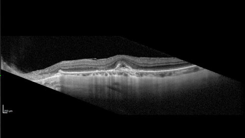 Myopic (maybe PIC) choroidal neovascular membrane with recurrence after 6 years
31 year old female presented with 20/100 vision OS in 2017.  Was treated with Lucentis x 6 and improved to 20/32.  Then she was lost to follow-up.  She represented 6 years later with 20/50 vision OS and a large recurrence and restarted treatment.
