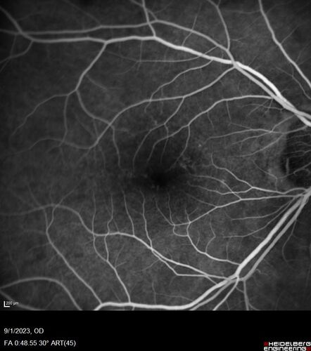 Myopic (maybe PIC) choroidal neovascular membrane with recurrence after 6 years
31 year old female presented with 20/100 vision OS in 2017.  Was treated with Lucentis x 6 and improved to 20/32.  Then she was lost to follow-up.  She represented 6 years later with 20/50 vision OS and a large recurrence and restarted treatment.
