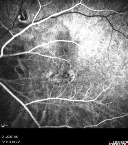 Myopic (maybe PIC) choroidal neovascular membrane with recurrence after 6 years
31 year old female presented with 20/100 vision OS in 2017.  Was treated with Lucentis x 6 and improved to 20/32.  Then she was lost to follow-up.  She represented 6 years later with 20/50 vision OS and a large recurrence and restarted treatment.
