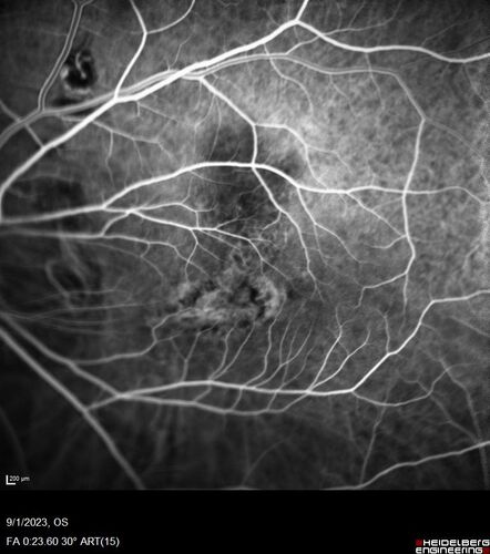 Myopic (maybe PIC) choroidal neovascular membrane with recurrence after 6 years
31 year old female presented with 20/100 vision OS in 2017.  Was treated with Lucentis x 6 and improved to 20/32.  Then she was lost to follow-up.  She represented 6 years later with 20/50 vision OS and a large recurrence and restarted treatment.
