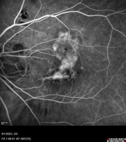 Myopic (maybe PIC) choroidal neovascular membrane with recurrence after 6 years
31 year old female presented with 20/100 vision OS in 2017.  Was treated with Lucentis x 6 and improved to 20/32.  Then she was lost to follow-up.  She represented 6 years later with 20/50 vision OS and a large recurrence and restarted treatment.
