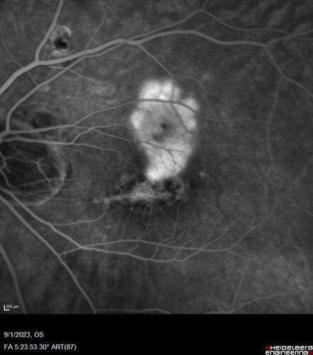 Myopic (maybe PIC) choroidal neovascular membrane with recurrence after 6 years
31 year old female presented with 20/100 vision OS in 2017.  Was treated with Lucentis x 6 and improved to 20/32.  Then she was lost to follow-up.  She represented 6 years later with 20/50 vision OS and a large recurrence and restarted treatment.

