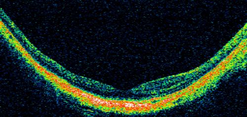 Myopic Choroidal Neovascular Membrane 54 year old woman 20/20
54-year-old woman has had problems in her vision in the right eye for about the last three months.  Inferotemporally she sees a gray area, which is distorted.   OD is 20/20, OS is 20/20
Keywords: myopic degeneration;wet;cnvm;