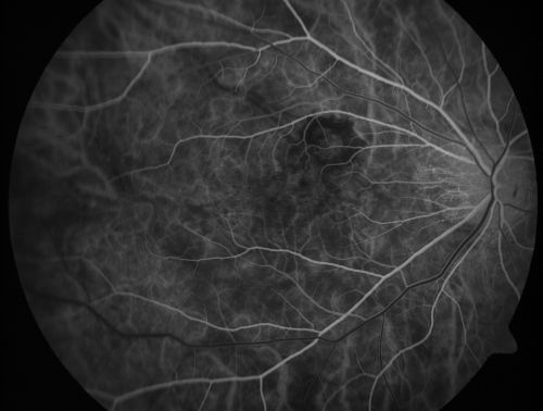 Myopic Choroidal Neovascular Membrane 54 year old woman 20/20
54-year-old woman has had problems in her vision in the right eye for about the last three months.  Inferotemporally she sees a gray area, which is distorted.   OD is 20/20, OS is 20/20
Palabras clave: myopic degeneration;wet;cnvm;