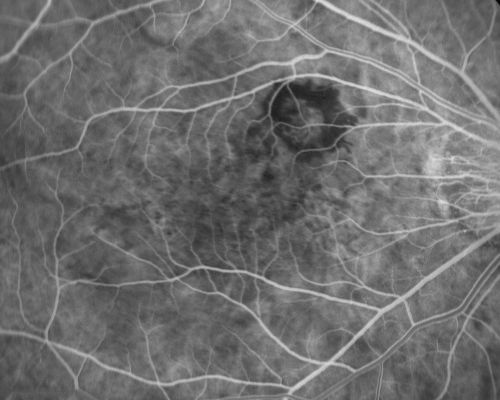 Myopic Choroidal Neovascular Membrane 54 year old woman 20/20
54-year-old woman has had problems in her vision in the right eye for about the last three months.  Inferotemporally she sees a gray area, which is distorted.   OD is 20/20, OS is 20/20
Keywords: myopic degeneration;wet;cnvm;