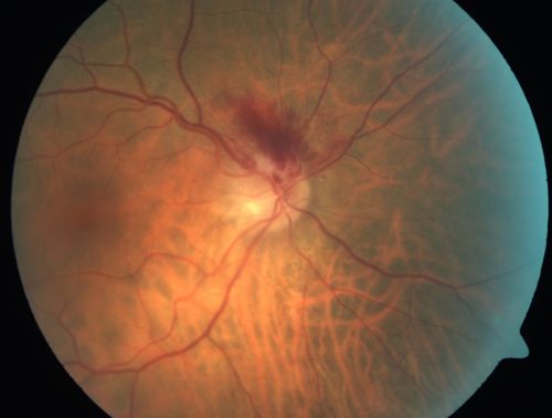 Acute Non-arteritic Anterior Ischemic Optic Neuropathy Right Eye - Previous NA-AION left eye 
69-year-old man previously lost vision in the left eye from nonarteritic anterior ischemic optic neuropathy in 2006.  About a week ago and noticed blurred vision in the inferonasal part of the vision in the right eye.  

VISUAL ACUITY:  Vision OD is 20/16, OS is 20/40
