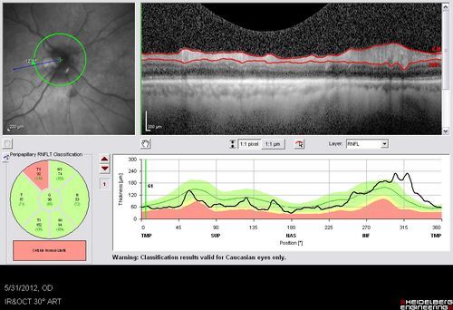 Acute Non-arteritic Anterior Ischemic Optic Neuropathy Right Eye - Previous NA-AION left eye 
69-year-old man previously lost vision in the left eye from nonarteritic anterior ischemic optic neuropathy in 2006.  About a week ago and noticed blurred vision in the inferonasal part of the vision in the right eye.  

VISUAL ACUITY:  Vision OD is 20/16, OS is 20/40
