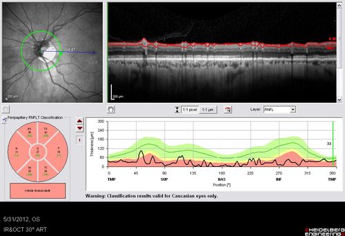 Acute Non-arteritic Anterior Ischemic Optic Neuropathy Right Eye - Previous NA-AION left eye 
69-year-old man previously lost vision in the left eye from nonarteritic anterior ischemic optic neuropathy in 2006.  About a week ago and noticed blurred vision in the inferonasal part of the vision in the right eye.  

VISUAL ACUITY:  Vision OD is 20/16, OS is 20/40
