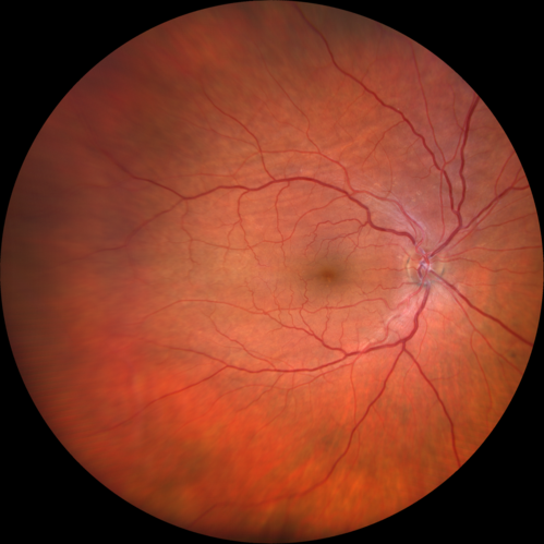 Choroidal Folds - Nanophthalmous - Axial length 20
67 year old female Decreased Vision OU with choriodal folds.  Axial length is 20.  There is a CHRPE lesion in the left eye.
VA 20/25 OU.  Has already had cataract and glaucoma surgery.
