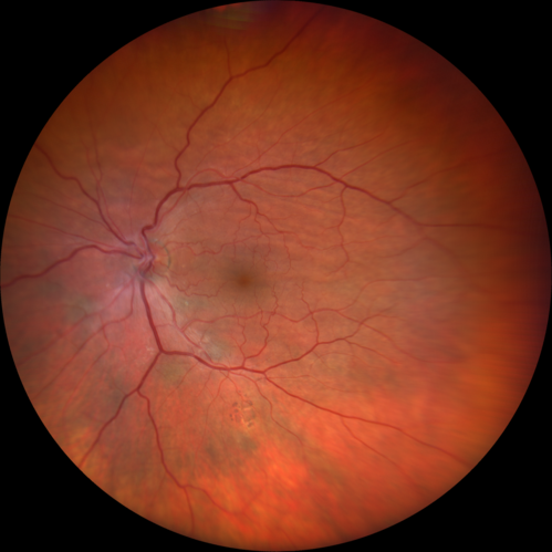 Choroidal Folds - Nanophthalmous - Axial length 20
67 year old female Decreased Vision OU with choriodal folds.  Axial length is 20.  There is a CHRPE lesion in the left eye.
VA 20/25 OU.  Has already had cataract and glaucoma surgery.
