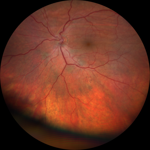 Choroidal Folds - Nanophthalmous - Axial length 20
67 year old female Decreased Vision OU with choriodal folds.  Axial length is 20.  There is a CHRPE lesion in the left eye.
VA 20/25 OU.  Has already had cataract and glaucoma surgery.
