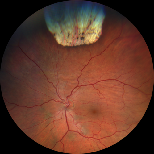 Choroidal Folds - Nanophthalmous - Axial length 20
67 year old female Decreased Vision OU with choriodal folds.  Axial length is 20.  There is a CHRPE lesion in the left eye.
VA 20/25 OU.  Has already had cataract and glaucoma surgery.
