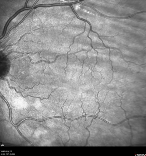 Choroidal Folds - Nanophthalmous - Axial length 20
67 year old female Decreased Vision OU with choriodal folds.  Axial length is 20.  There is a CHRPE lesion in the left eye.
VA 20/25 OU.  Has already had cataract and glaucoma surgery.
