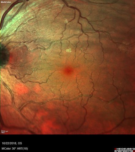 Choroidal Folds - Nanophthalmous - Axial length 20
67 year old female Decreased Vision OU with choriodal folds.  Axial length is 20.  There is a CHRPE lesion in the left eye.
VA 20/25 OU.  Has already had cataract and glaucoma surgery.
