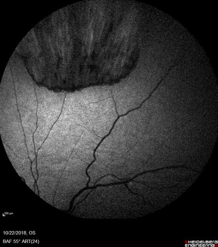 Choroidal Folds - Nanophthalmous - Axial length 20
67 year old female Decreased Vision OU with choriodal folds.  Axial length is 20.  There is a CHRPE lesion in the left eye.
VA 20/25 OU.  Has already had cataract and glaucoma surgery.
