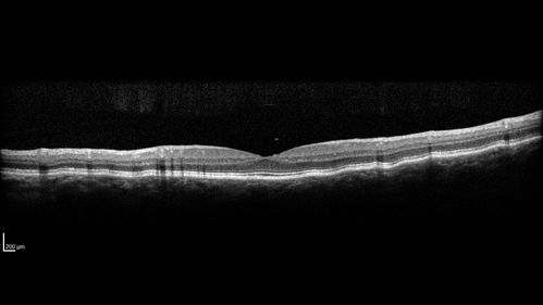 Choroidal Folds - Nanophthalmous - Axial length 20
67 year old female Decreased Vision OU with choriodal folds.  Axial length is 20.  There is a CHRPE lesion in the left eye.
VA 20/25 OU.  Has already had cataract and glaucoma surgery.
