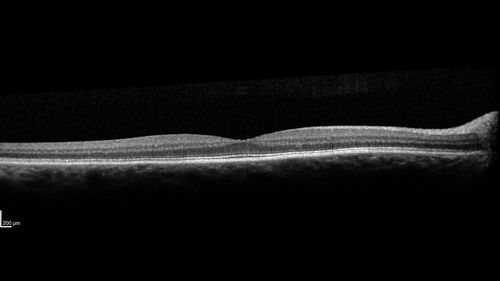 Choroidal Folds - Nanophthalmous - Axial length 20
67 year old female Decreased Vision OU with choriodal folds.  Axial length is 20.  There is a CHRPE lesion in the left eye.
VA 20/25 OU.  Has already had cataract and glaucoma surgery.
