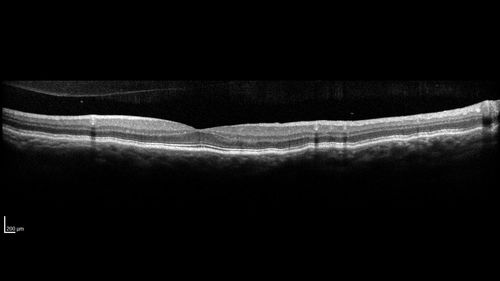 Choroidal Folds - Nanophthalmous - Axial length 20
67 year old female Decreased Vision OU with choriodal folds.  Axial length is 20.  There is a CHRPE lesion in the left eye.
VA 20/25 OU.  Has already had cataract and glaucoma surgery.
