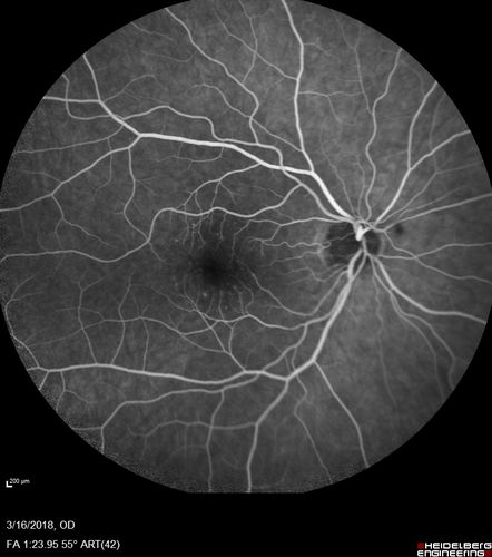 Cilioretinal Artery Occlusion - Nasal (not macular)
77 year old female There is a shadow in the top half of her temporal vision in the left eye that came on suddenly yesterday morning.Â  It has not changed since then and the right eye is OK.Â  She has had sinus headaches.Â  She had no focal neurological changes.Â Â 
VA OD: Dcc20/32 
VA OS: Dcc20/16-1 
IOP: TP: OD:18 OS:19Â 
