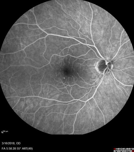 Cilioretinal Artery Occlusion - Nasal (not macular)
77 year old female There is a shadow in the top half of her temporal vision in the left eye that came on suddenly yesterday morning.Â  It has not changed since then and the right eye is OK.Â  She has had sinus headaches.Â  She had no focal neurological changes.Â Â 
VA OD: Dcc20/32 
VA OS: Dcc20/16-1 
IOP: TP: OD:18 OS:19Â 
