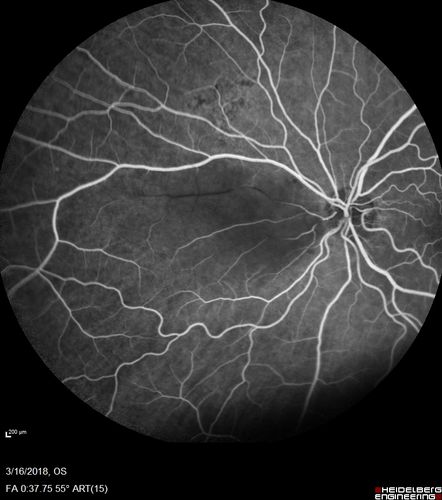 Cilioretinal Artery Occlusion - Nasal (not macular)
77 year old female There is a shadow in the top half of her temporal vision in the left eye that came on suddenly yesterday morning.Â  It has not changed since then and the right eye is OK.Â  She has had sinus headaches.Â  She had no focal neurological changes.Â Â 
VA OD: Dcc20/32 
VA OS: Dcc20/16-1 
IOP: TP: OD:18 OS:19Â 
