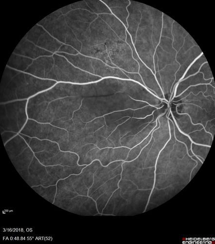 Cilioretinal Artery Occlusion - Nasal (not macular)
77 year old female There is a shadow in the top half of her temporal vision in the left eye that came on suddenly yesterday morning.Â  It has not changed since then and the right eye is OK.Â  She has had sinus headaches.Â  She had no focal neurological changes.Â Â 
VA OD: Dcc20/32 
VA OS: Dcc20/16-1 
IOP: TP: OD:18 OS:19Â 
