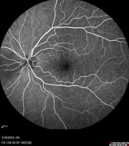 Cilioretinal Artery Occlusion - Nasal (not macular)
77 year old female There is a shadow in the top half of her temporal vision in the left eye that came on suddenly yesterday morning.Â  It has not changed since then and the right eye is OK.Â  She has had sinus headaches.Â  She had no focal neurological changes.Â Â 
VA OD: Dcc20/32 
VA OS: Dcc20/16-1 
IOP: TP: OD:18 OS:19Â 
