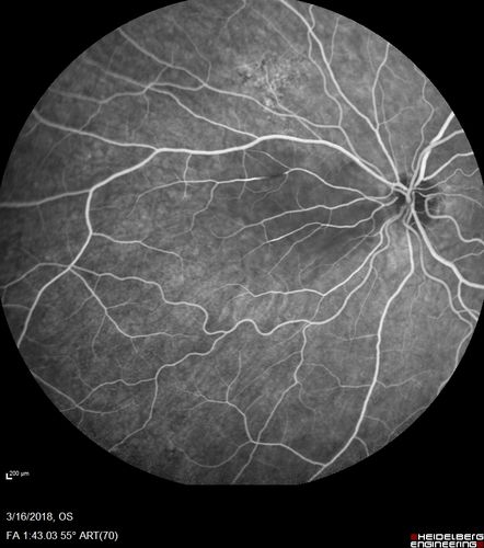 Cilioretinal Artery Occlusion - Nasal (not macular)
77 year old female There is a shadow in the top half of her temporal vision in the left eye that came on suddenly yesterday morning.Â  It has not changed since then and the right eye is OK.Â  She has had sinus headaches.Â  She had no focal neurological changes.Â Â 
VA OD: Dcc20/32 
VA OS: Dcc20/16-1 
IOP: TP: OD:18 OS:19Â 

