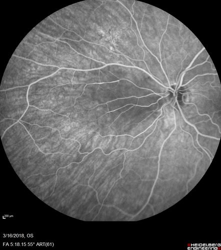 Cilioretinal Artery Occlusion - Nasal (not macular)
77 year old female There is a shadow in the top half of her temporal vision in the left eye that came on suddenly yesterday morning.Â  It has not changed since then and the right eye is OK.Â  She has had sinus headaches.Â  She had no focal neurological changes.Â Â 
VA OD: Dcc20/32 
VA OS: Dcc20/16-1 
IOP: TP: OD:18 OS:19Â 
