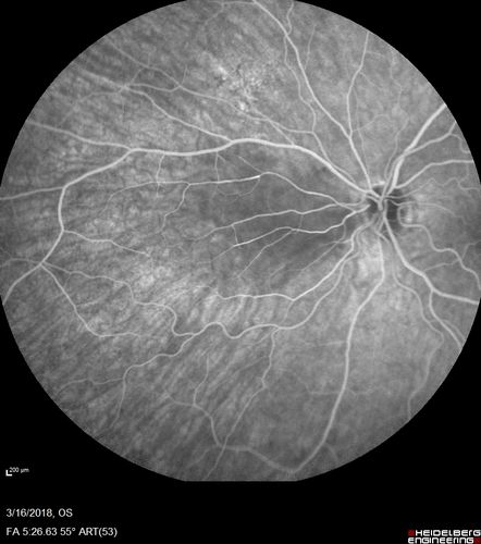 Cilioretinal Artery Occlusion - Nasal (not macular)
77 year old female There is a shadow in the top half of her temporal vision in the left eye that came on suddenly yesterday morning.Â  It has not changed since then and the right eye is OK.Â  She has had sinus headaches.Â  She had no focal neurological changes.Â Â 
VA OD: Dcc20/32 
VA OS: Dcc20/16-1 
IOP: TP: OD:18 OS:19Â 
