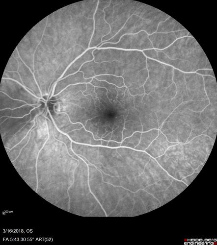 Cilioretinal Artery Occlusion - Nasal (not macular)
77 year old female There is a shadow in the top half of her temporal vision in the left eye that came on suddenly yesterday morning.Â  It has not changed since then and the right eye is OK.Â  She has had sinus headaches.Â  She had no focal neurological changes.Â Â 
VA OD: Dcc20/32 
VA OS: Dcc20/16-1 
IOP: TP: OD:18 OS:19Â 
