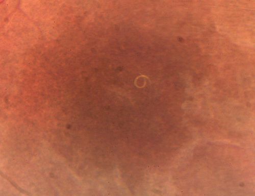 DUSN - Diffuse Unilateral Subacute Neuroretinitis - Nematode
