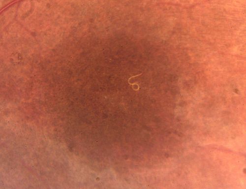 DUSN - Diffuse Unilateral Subacute Neuroretinitis - Nematode
