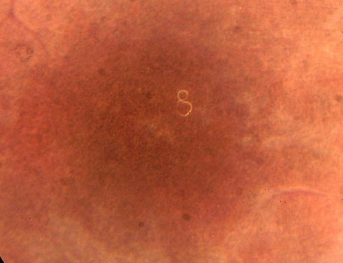 DUSN - Diffuse Unilateral Subacute Neuroretinitis - Nematode
