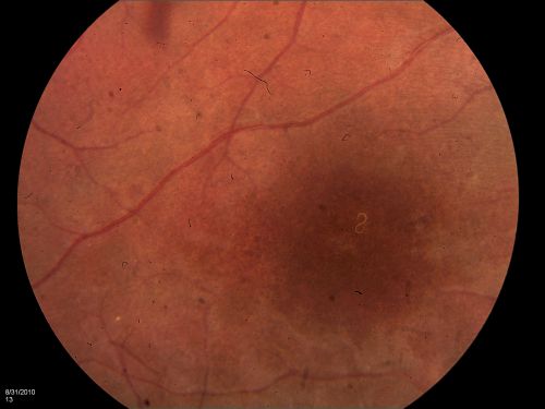 DUSN - Diffuse Unilateral Subacute Neuroretinitis - Nematode
